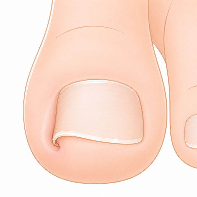 陥入爪のイメージ