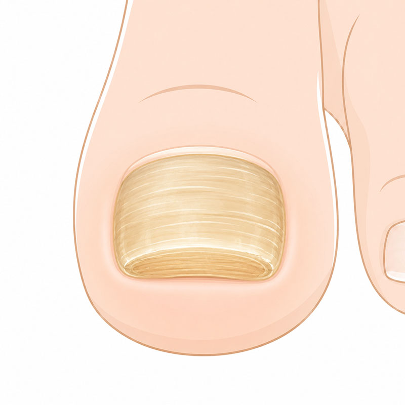 肥厚爪のイメージ